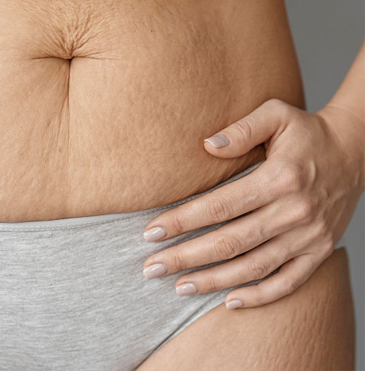 Nadmiar skóry na brzuchu<br />
Ujędrnij ciało po ciąży lub szybkiej zmianie wagi<br />
